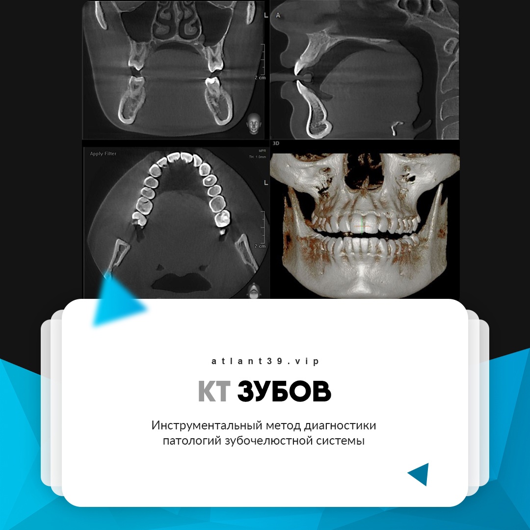 Компьютерная томография зубов КТ МРТ - Атлант