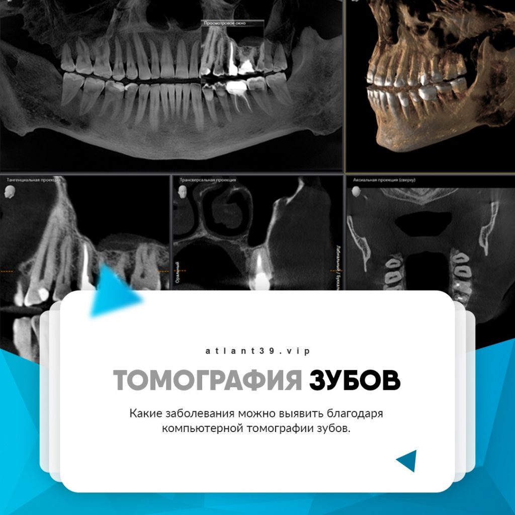 Компьютерная томография зубов в Калининграде, КТ зубов