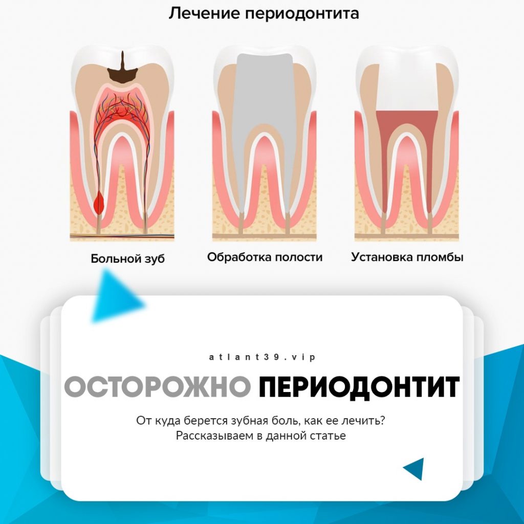 Периодонтит, причины и лечение в Калининграде