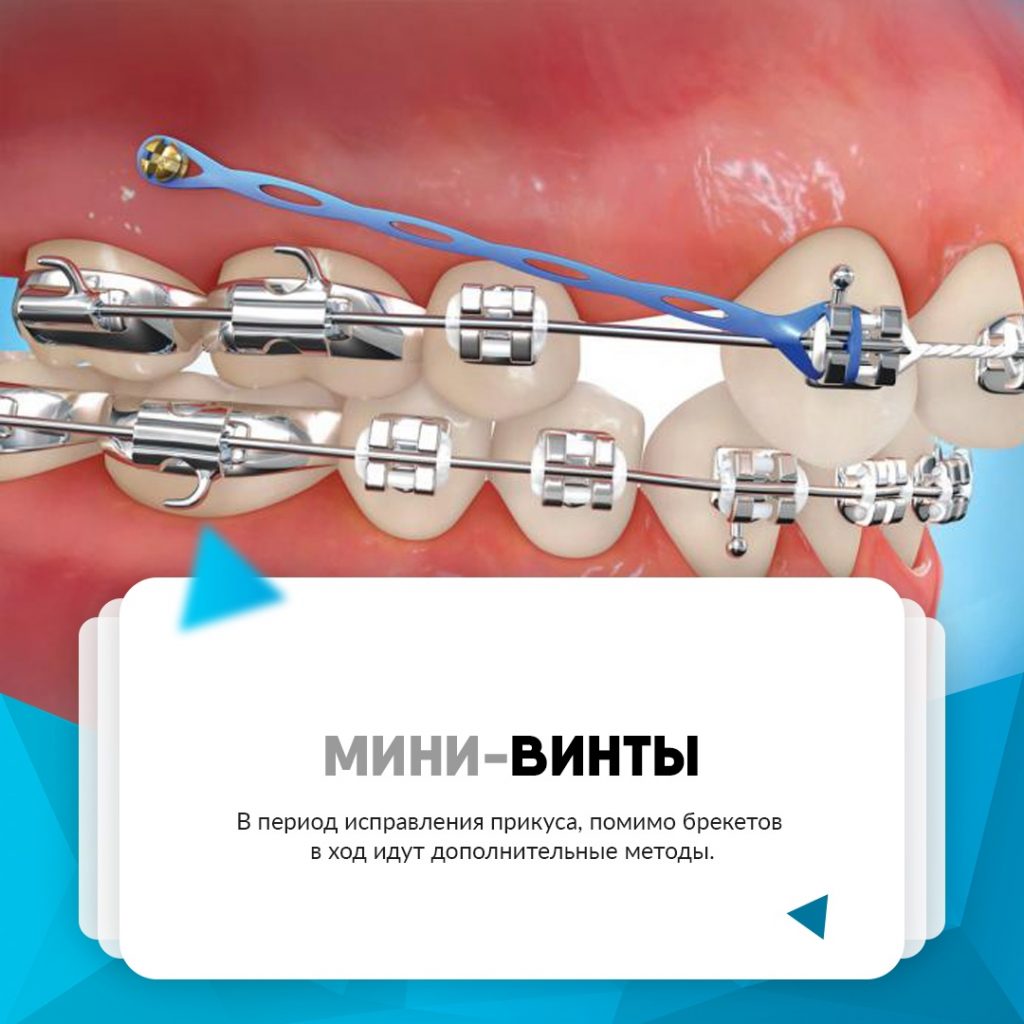 Мини-винты для прикуса в стоматологии