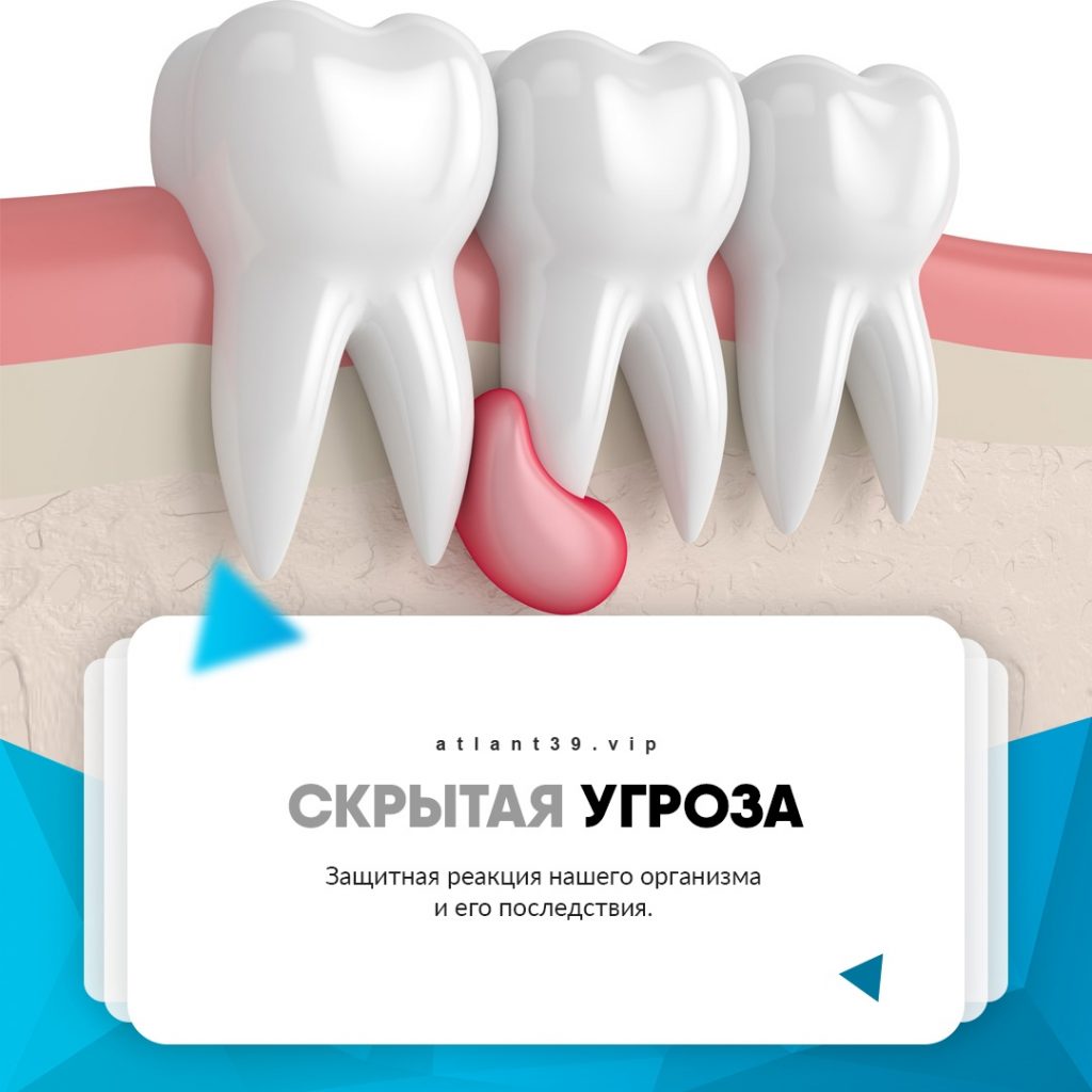 Скрытая угроза: чем опасна киста зуба?